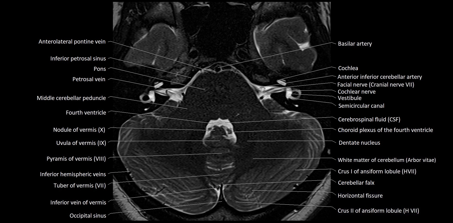 MRI Cerebellar anatomy High-resolution labelled 3T MRI image 13.webp